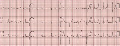 Dr. Smith's ECG Blog: HyperKalemia with Cardiac Arrest. Peaked T waves ...