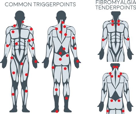 Back trigger points chart self massage trigger point guide – Artofit