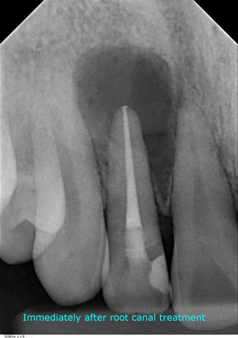 Root Canal Safety - Saddleback Valley Endodontics