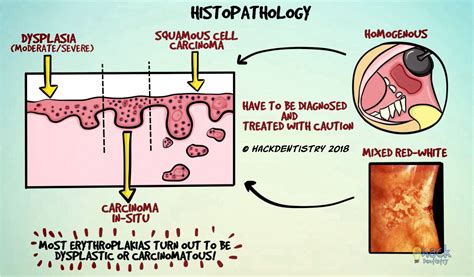 Erythroplakia Histopathology