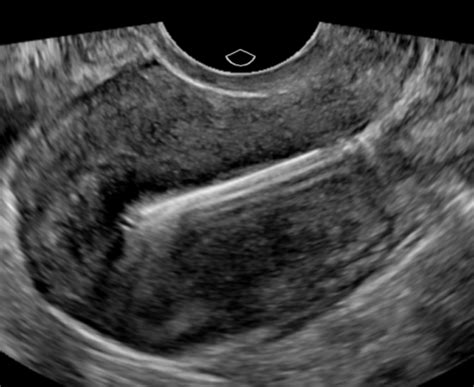 Accurate detection of IUD placement using 3D ultrasound - Sononotes