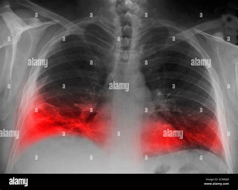 Radiographie montrant un infiltrat pulmonaire d'une pneumonie Photo Stock - Alamy