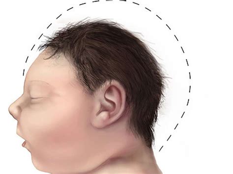 Microcephaly: Causes, symptoms, and treatment