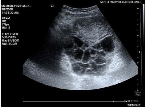 Case 2: Ovarian theca lutein cysts (ultrasonography at 14 weeks of... | Download Scientific ...