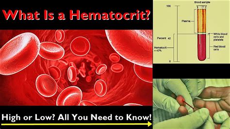 Anemia Hematocrit Levels