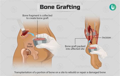 Bone grafting: Procedure, Purpose, Results, Cost, Price