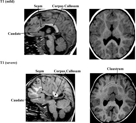 semilobar holoprosencephaly mri -alobar -lobar - Google Search | Health ...