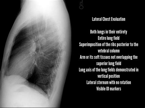 Normal Lateral Chest Radiograph