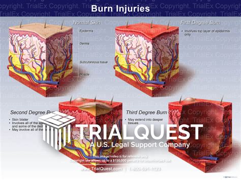 Burn Injuries - TrialExhibits Inc.