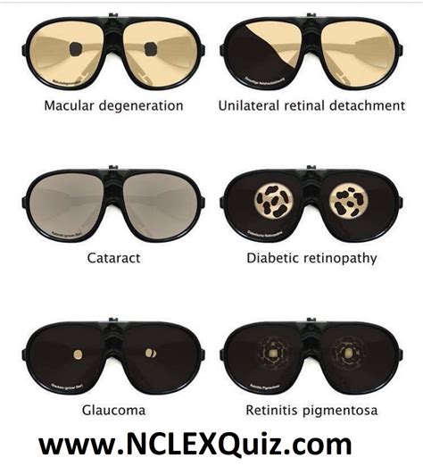 Types of Vision Loss Cheat Sheet - NCLEX Quiz