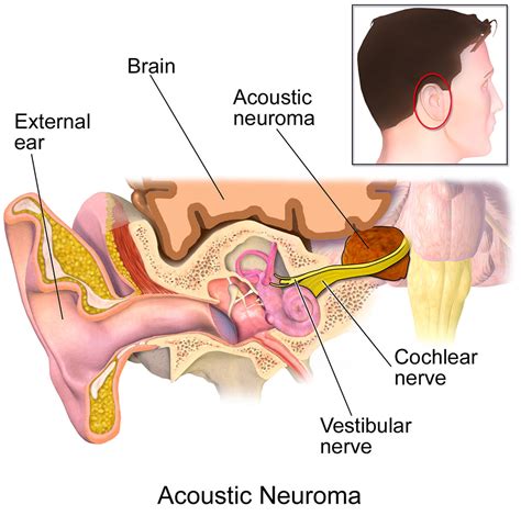 Acoustic Neuromas: What You Need to Know - Better Hearing Australia