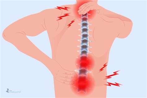 Arthritis in the Back: Symptoms, Types of Back Arthritis, Treatment