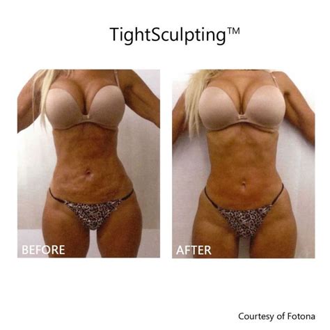 Body Laser Skin Tightening - NYC and Long Island New York | Laser skin ...