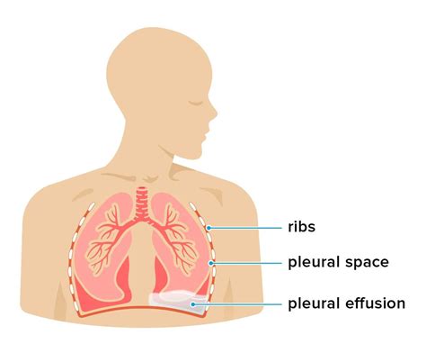 Hepatic Hydrothorax: Symptoms, Causes, Diagnosis, Treatment