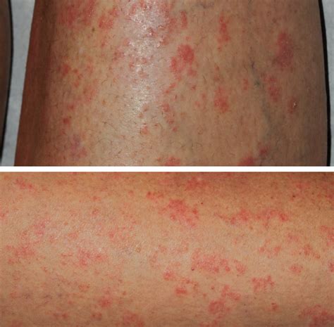 What is the cause of this patient’s psoriasis flare? | Consultant360