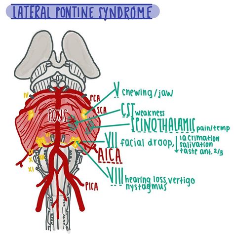 Medial Pontine Syndrome