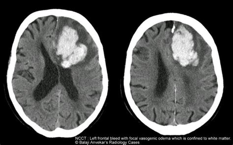 Dr Balaji Anvekar's Neuroradiology Cases: Cytotoxic vs Vasogenic odema