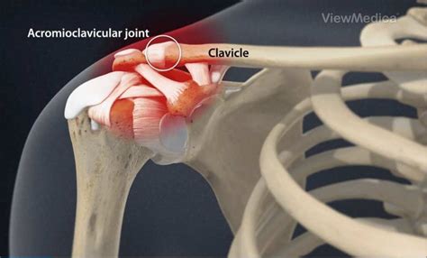 Acromioclavicular Joint | AC Joint in shoulder, AC Joint Pain