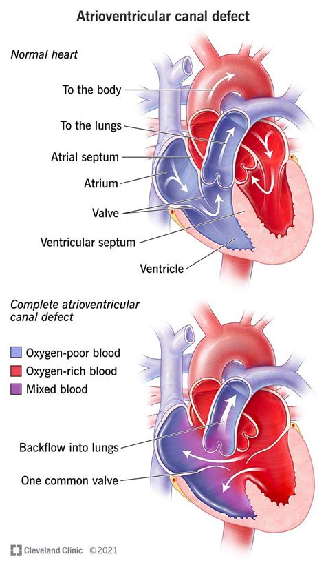 Atrioventricular Canal (AVC) Defect