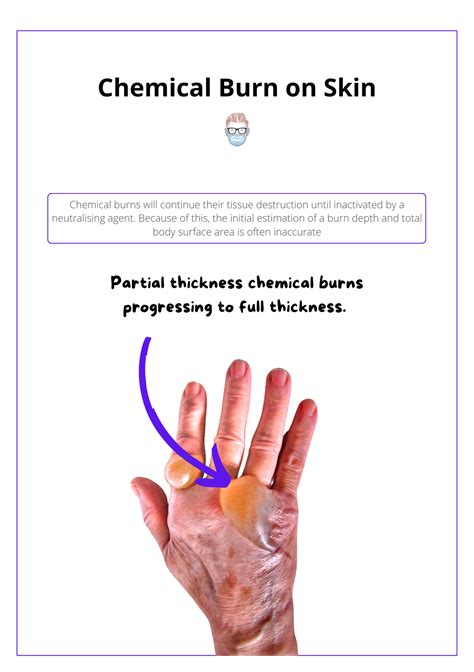 Chemical Burns · Types, Complications, Management