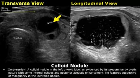 Thyroid Ultrasound Reporting | How To Write USG Scan Reports | Thyroid Pathologies | Small Parts ...