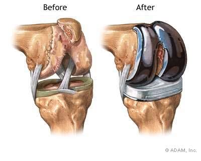 The New York Times > Health > Image > Knee Joint Replacement Prosthesis