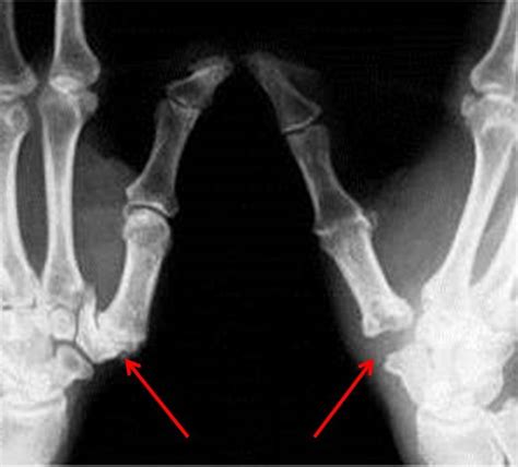 On the left is an arthritic thumb basilar joint; on the right is what ...