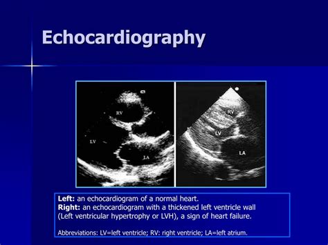 PPT - Systolic and Diastolic Heart Failure PowerPoint Presentation, free download - ID:1410892