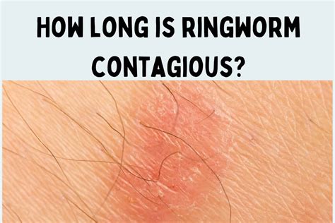 How Long is Ringworm Contagious, if Treated vs Untreated?