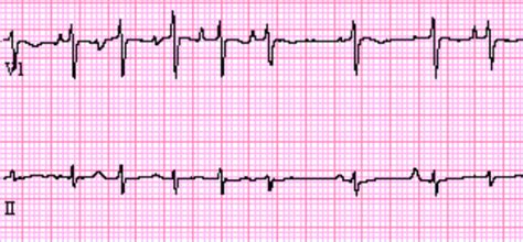 Multifocal Atrial Tachycardia - ECG Made Simple