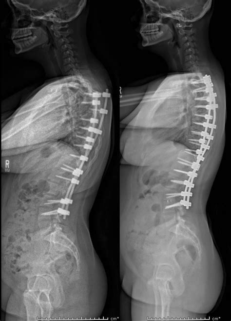 Previously-Operated Scoliosis | Scoliosis Texas