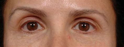 Eyelid Thermage Before and After Pictures | Santa Monica Laser and Skin Care Center