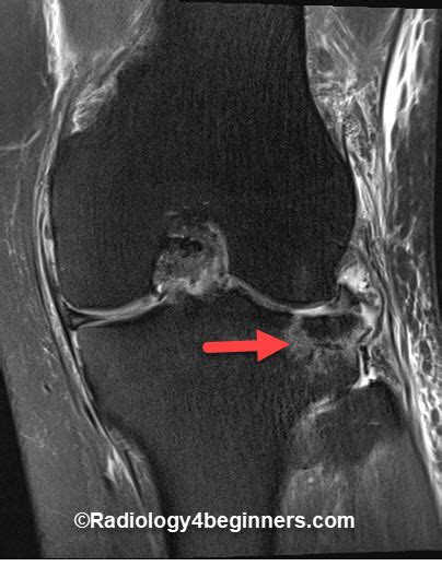 SegondFracture Radiology - ACL injury | Radiology For Beginners