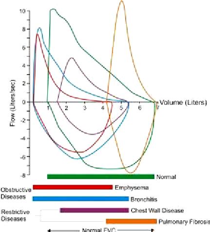 This illustration shows the variety of flow volume loop shapes that ...