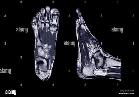 Manetic resonance imaging of foot or MRI FOOT PDW axial, Coronal and sagittal view for ...