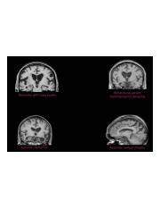 Dementia Brain Scans II.png - | Course Hero