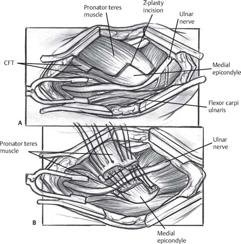 Right Ulnar Nerve Transposition Surgery