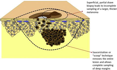 Guidelines of care for the management of primary cutaneous melanoma ...