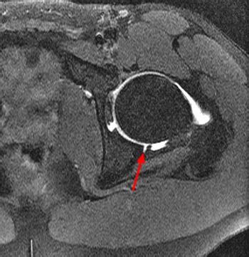 Acetabular Labral Tear - Radsource