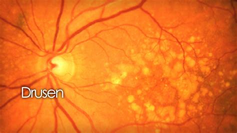 Drusen | small deposits in the retina from macular degeneration