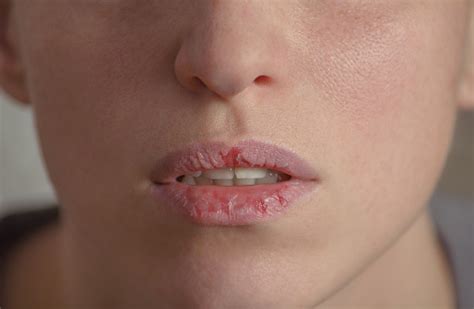 Dermatillomania Skin Picking Woman Has Bad Habit To Pick Her Lips ...