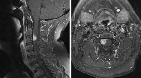 Extramedullary Spinal Cord Tumor | The Neurosurgical Atlas, by Aaron ...