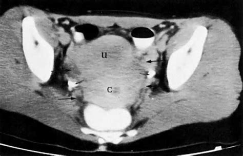 √ Uterus Endometriosis Ct Scan / Tumors Of The Uterine Corpus Clinical Gate : The best way to ...