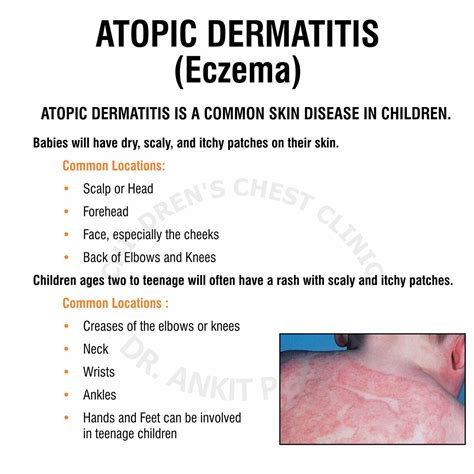 Atopic Dermatitis Eczema - Dr. Ankit Parakh