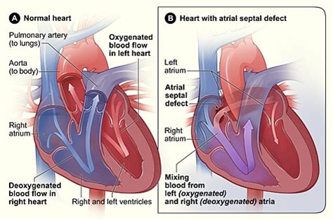 Congenital Heart Defects - Types | NHLBI, NIH