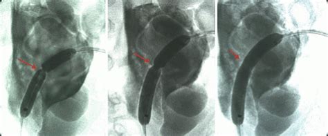 Pelviureteric Junction (PUJ) Obstruction | Abdominal Key