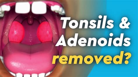 What Are Adenoids And Tonsils