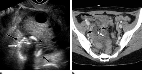 Periappendiceal abscess in a 35-year-old woman who presented with a ...