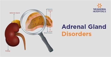 Adrenal Gland Disorders: Types, Causes, Symptoms, Diagnosis, Treatment and Complications