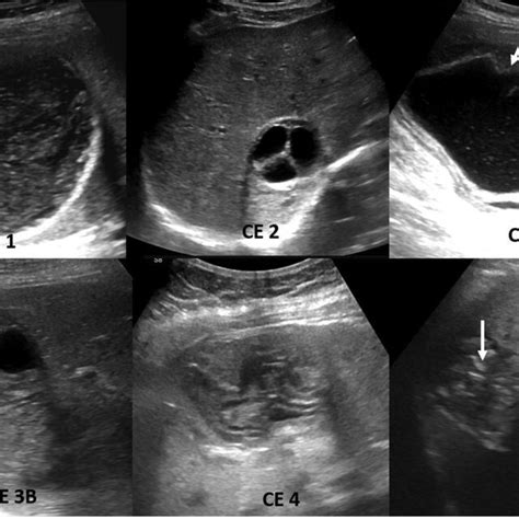 Hydatid cyst: Ultrasound. Multiple stages of hydatid cyst are shown.... | Download Scientific ...